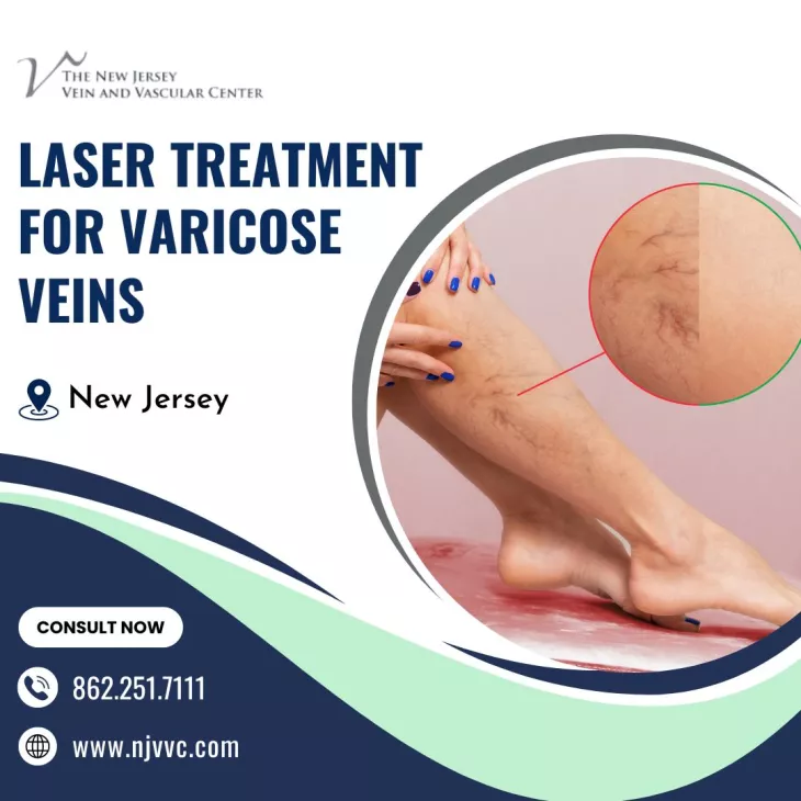 Laser treatment for varicose veins by NJVVC in Randolph, New Jersey