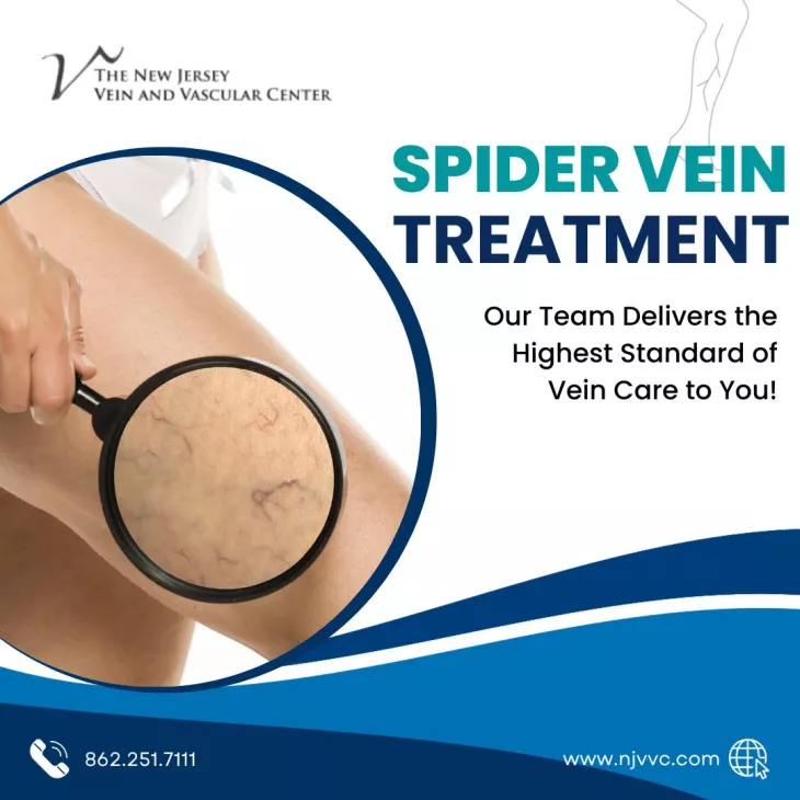 spider vein treatment by Dr. Stuart Miller in Randolph,NJ