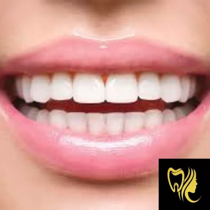 Best Teeth Whitening Treatment in Mogappair