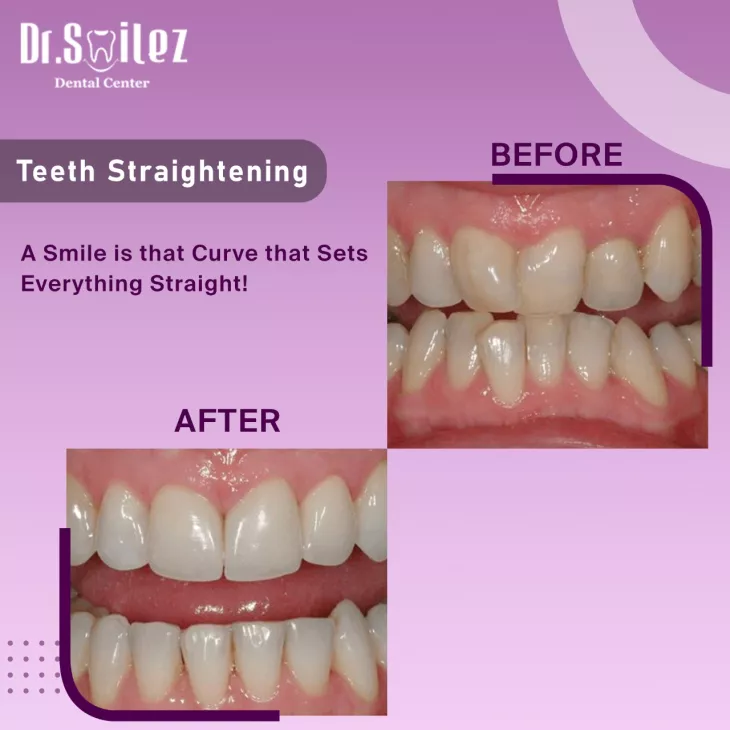 Tooth Replacement services in Chennai
