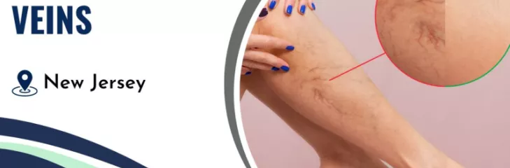 Laser treatment for varicose veins by NJVVC in Randolph, New Jersey