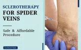  Spider Veins  Treatment in New Jersey