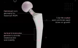 Orthopedic implants