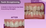Tooth Replacement services in Chennai